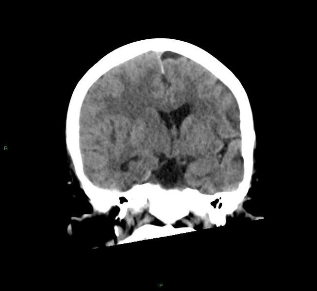 File:Cerebral amyloid angiopathy-associated lobar intracerebral hemorrhage (Radiopaedia 58563-65727 Coronal non-contrast 38).jpg
