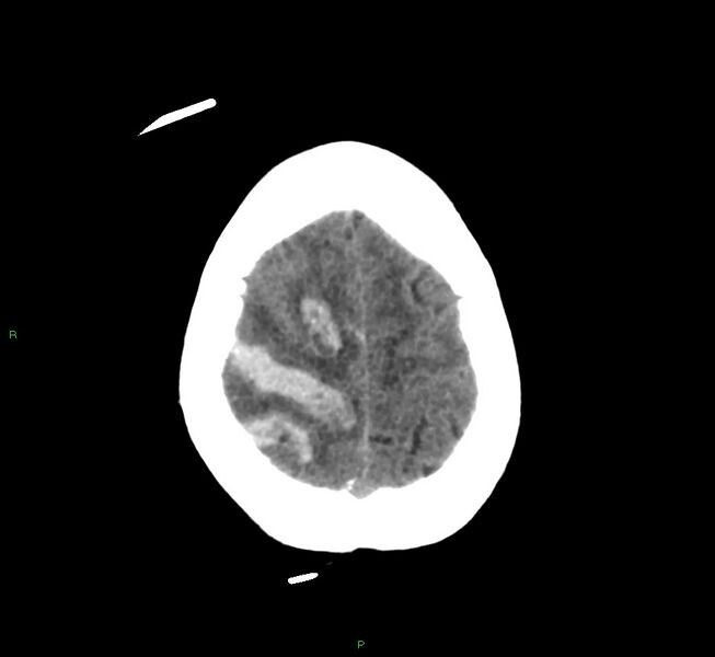 File:Cerebral amyloid angiopathy-associated lobar intracerebral hemorrhage (Radiopaedia 58566-65730 Axial non-contrast 9).jpg