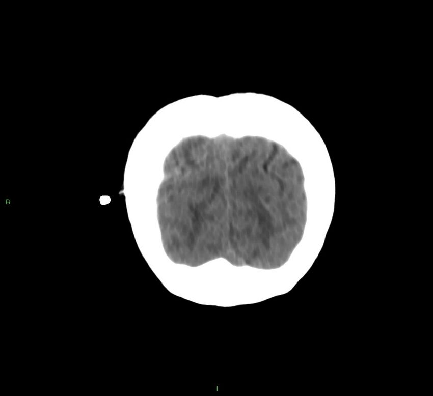 Cerebral amyloid angiopathy-associated lobar intracerebral hemorrhage (Radiopaedia 58566-65730 Coronal non-contrast 11).jpg