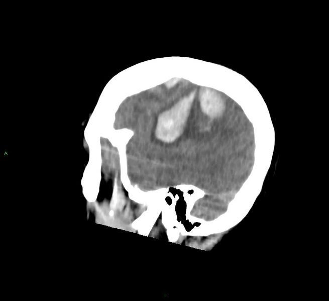 File:Cerebral amyloid angiopathy-associated lobar intracerebral hemorrhage (Radiopaedia 58756-65977 C 13).jpg