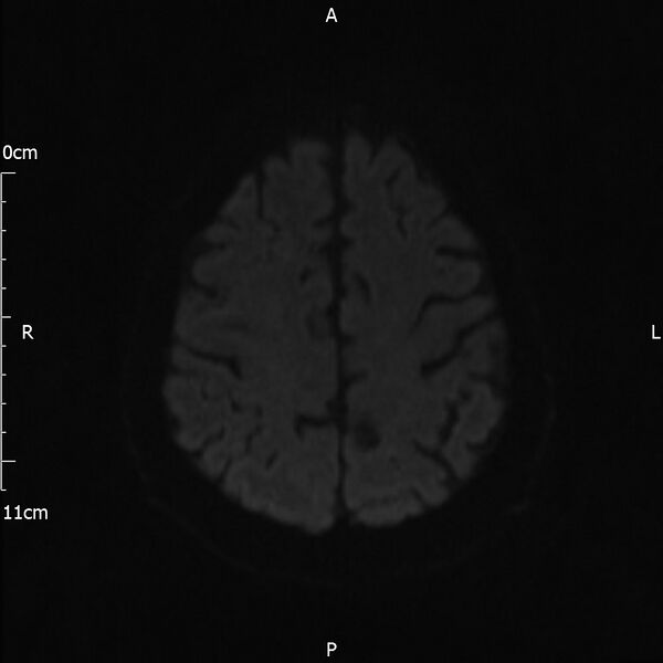 File:Cerebral amyloid angiopathy related inflammation (Radiopaedia 72772-83415 Axial DWI 64).jpg