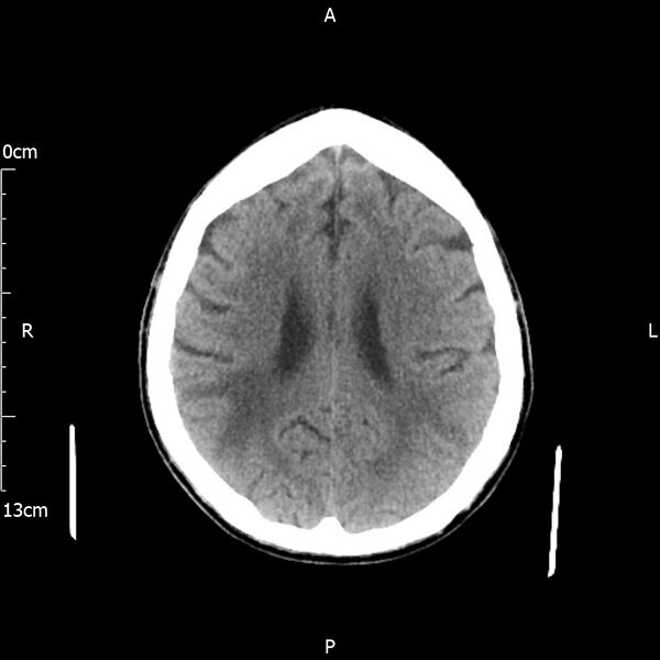 File:Cerebral amyloid angiopathy related inflammation (Radiopaedia 72772-83480 Axial non-contrast 18).jpg