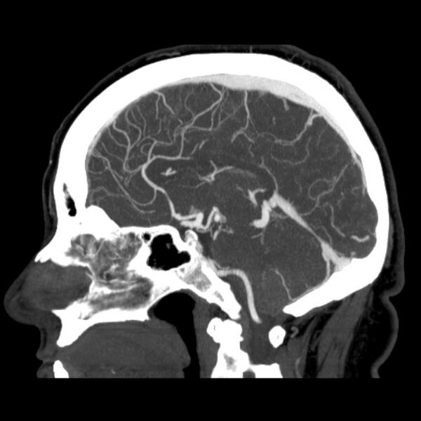 File:Cerebral arteriovenous malformation (Radiopaedia 43729-47189 D 26).jpg