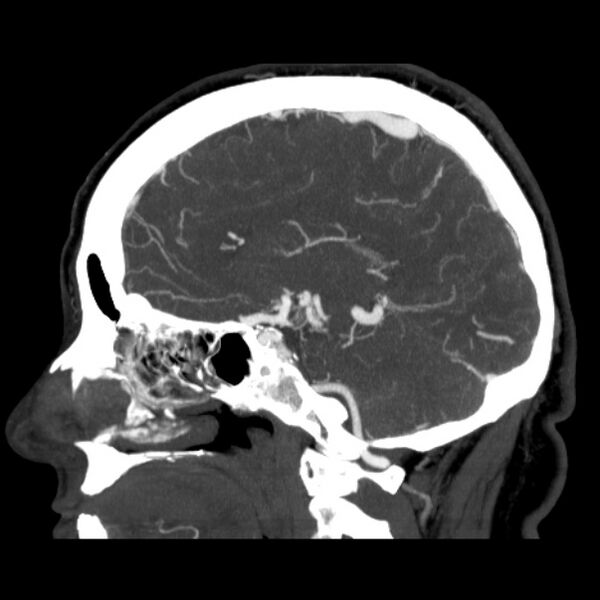 File:Cerebral arteriovenous malformation (Radiopaedia 43729-47189 D 28).jpg