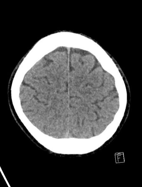 File:Cerebral arteriovenous malformation (Radiopaedia 78188-90745 Axial non-contrast 20).jpg