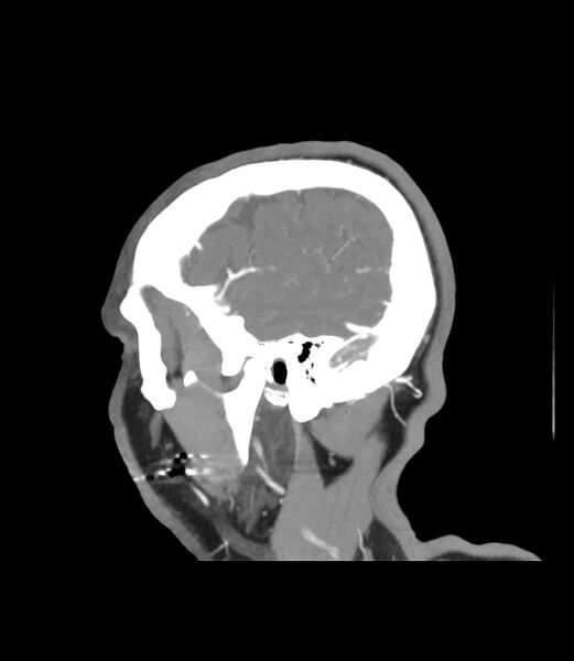 File:Cerebral dural venous sinus thrombosis (Radiopaedia 86514-102576 C 53).jpg