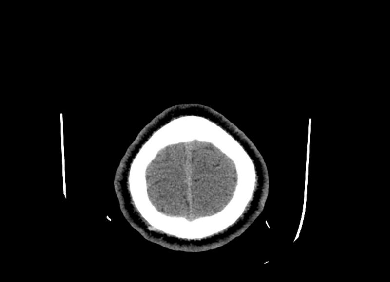 File:Cerebral edema (Radiopaedia 82519-96661 Axial non-contrast 6).jpg