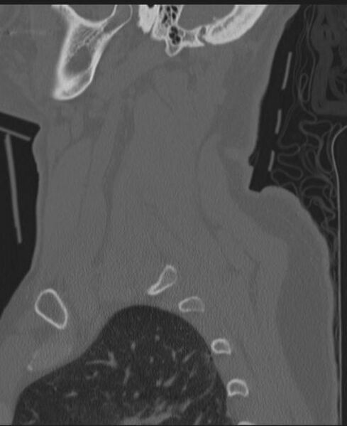 File:Cerebral hemorrhagic contusions and cervical spine fractures (Radiopaedia 32865-33841 Sagittal bone window 19).jpg