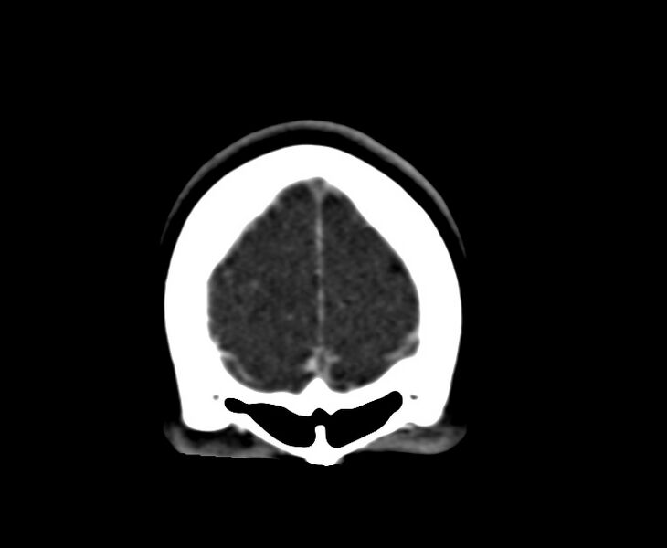 File:Cerebral venous sinus thrombosis (Radiopaedia 59224-66646 Coronal C+ delayed 4).jpg