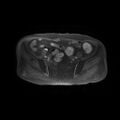 Cervical carcinoma (Radiopaedia 78847-91705 Axial T1 fat sat 4).jpg