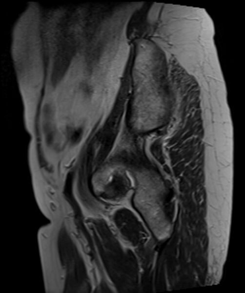 File:Cervical carcinoma (Radiopaedia 88312-104943 Sagittal T2 5).jpg