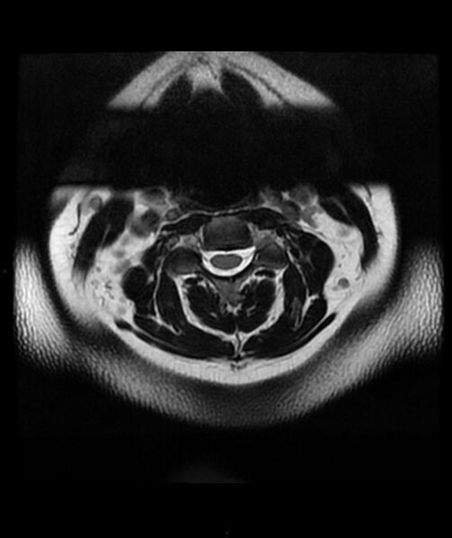 File:Cervical disc prolapse (Radiopaedia 80258-93598 Axial T2 7).jpg