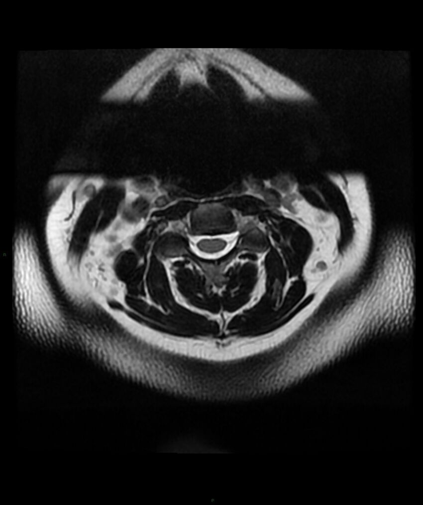 Cervical disc prolapse (Radiopaedia 80258-93598 Axial T2 7).jpg