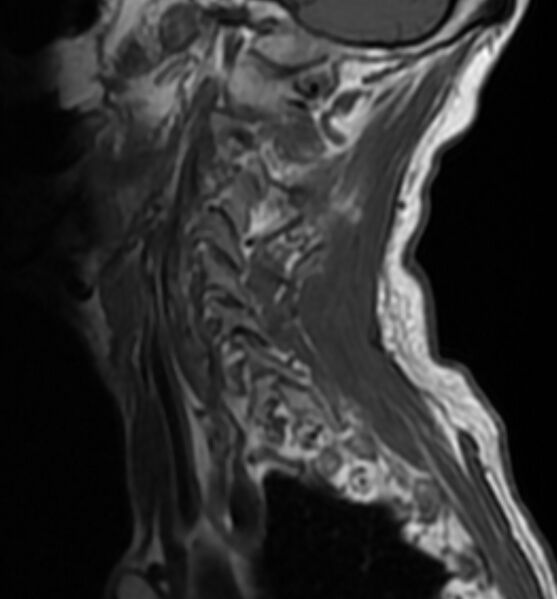 File:Cervical spondylodiscitis (Radiopaedia 81362-95110 Sagittal T1 3).jpg