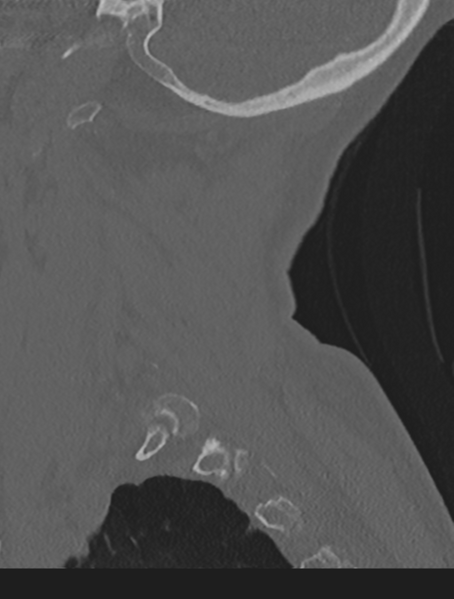 File:Cervical spondylolysis (Radiopaedia 49616-54811 Sagittal bone window 60).png