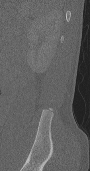 File:Chance fracture (Radiopaedia 40360-42912 Sagittal bone window 10).png