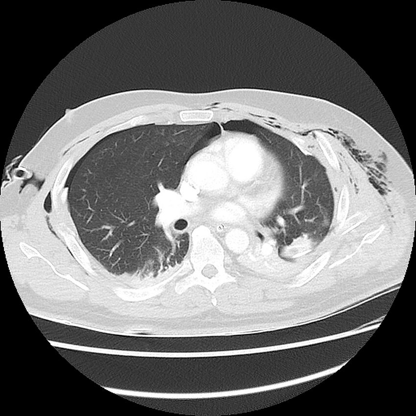 Chest crush injury (Radiopaedia 31620-32513 Axial lung window 29).jpg