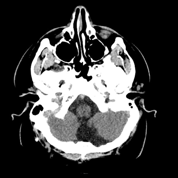 File:Chiasmatic-hypothalamic juvenile pilocytic astrocytoma (Radiopaedia 78533-91237 Axial non-contrast 12).jpg