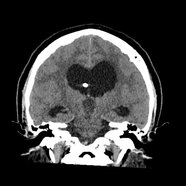 File:Chiasmatic-hypothalamic juvenile pilocytic astrocytoma (Radiopaedia 78533-91237 Coronal non-contrast 39).jpg