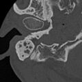 Cholesteatoma (Radiopaedia 15846-15494 bone window 29).jpg