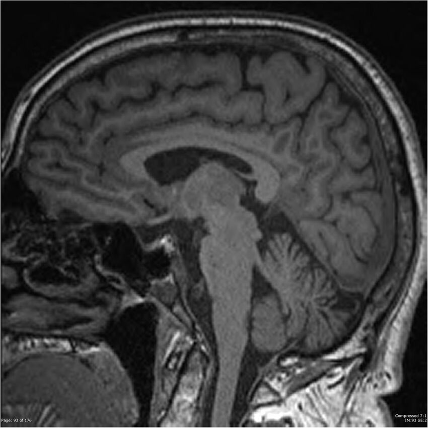 Chondrosarcoma of skull base- grade II (Radiopaedia 40948-43654 Sagittal T1 16).jpg