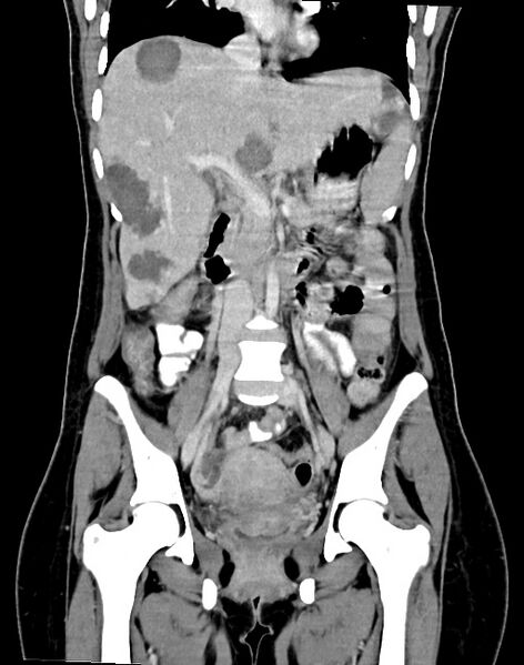 File:Choriocarcinoma liver metastases (Radiopaedia 74768-85766 B 53).jpg