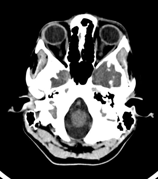 File:Choroid plexus carcinoma (Radiopaedia 91013-108552 Axial non-contrast 12).jpg