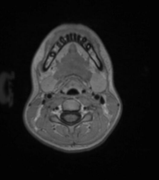 File:Choroid plexus carcinoma (Radiopaedia 91013-108553 Axial T1 C+ 23).jpg