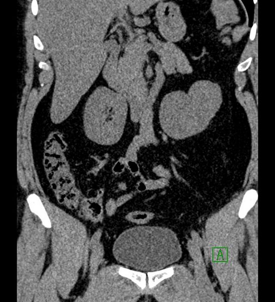 File:Chromophobe renal cell carcinoma (Radiopaedia 84286-99573 Coronal non-contrast 78).jpg