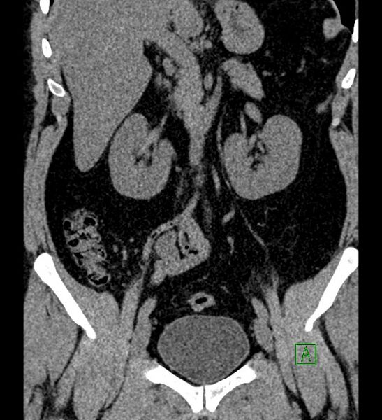 File:Chromophobe renal cell carcinoma (Radiopaedia 84286-99573 Coronal non-contrast 85).jpg