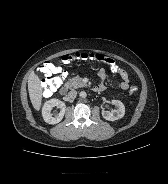 File:Chromophobe renal cell carcinoma (Radiopaedia 84337-99644 C 54).jpg