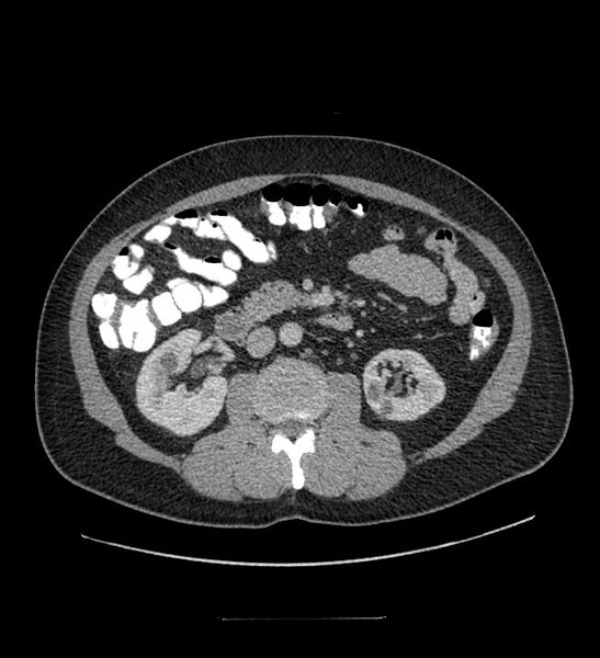 File:Chromophobe renal cell carcinoma (Radiopaedia 84337-99644 C 60).jpg
