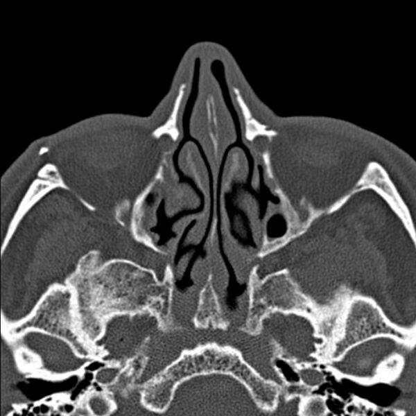 File:Chronic maxillary sinusitis (Radiopaedia 27879-28116 Axial bone window 24).jpg