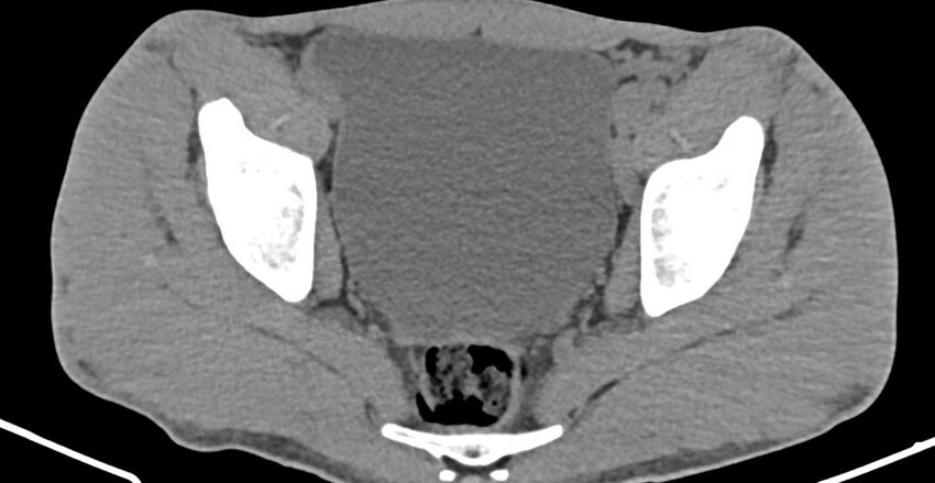 Chronic osteomyelitis (with sequestrum) (Radiopaedia 74813-85822 D 27).jpg