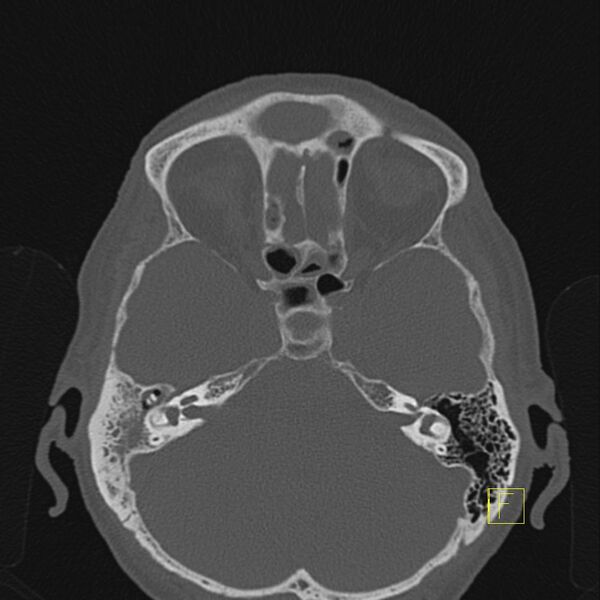 File:Chronic otitis media (Radiopaedia 14994-14912 Axial bone window 6).JPEG