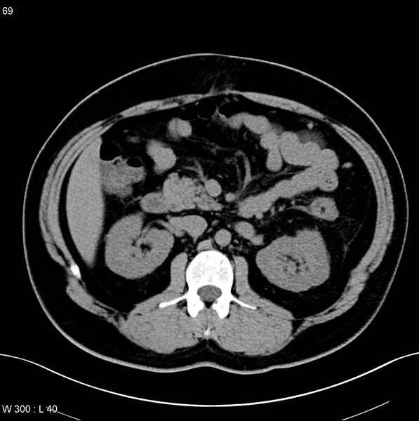 File:Chronic pancreatitis and pseudocysts (Radiopaedia 6724-7935 Axial non-contrast 13).jpg