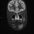 Chronic reactive multifocal osteomyelitis (CRMO) - mandible (Radiopaedia 56405-63069 Coronal STIR 12).jpg
