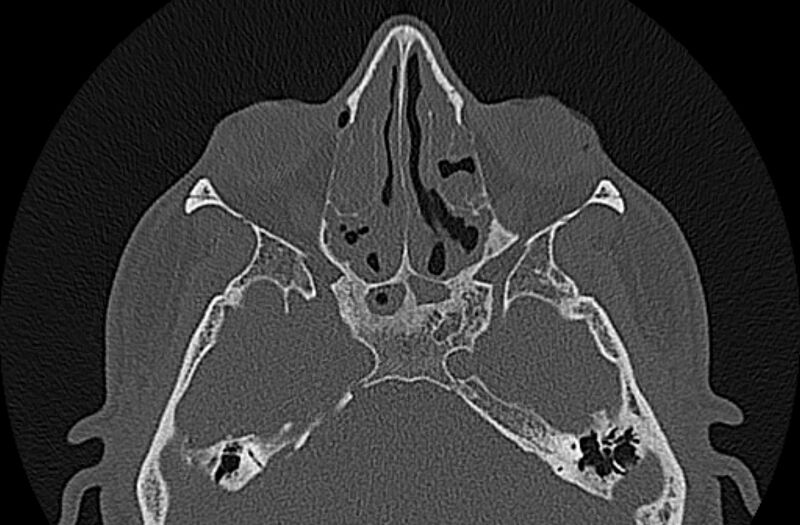 File:Chronic rhinosinusitis (Radiopaedia 65079-74075 Axial bone window 46).jpg