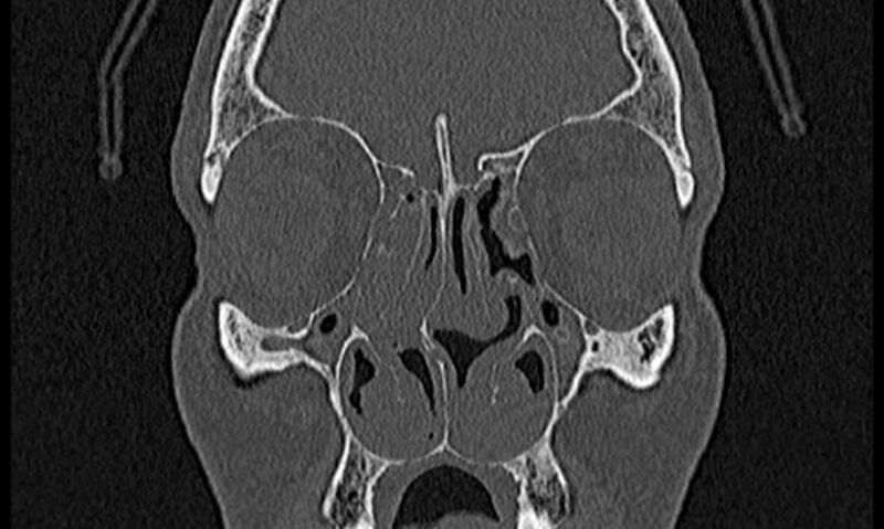 File:Chronic rhinosinusitis (Radiopaedia 65079-74075 Coronal bone window 27).jpg