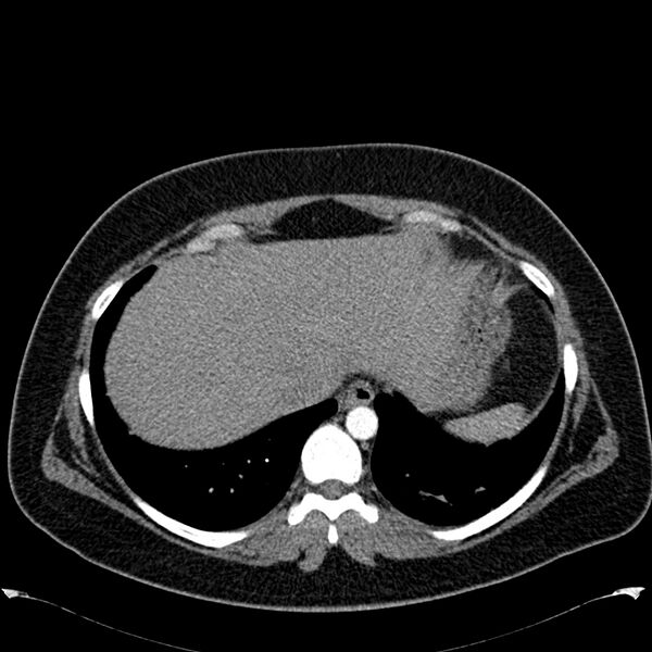 File:Chronic thromboembolic pulmonary hypertension (CTEPH) (Radiopaedia 74597-85531 Axial C+ CTPA 43).jpg