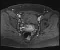 Class II Mullerian duct anomaly- unicornuate uterus with rudimentary horn and non-communicating cavity (Radiopaedia 39441-41755 Axial T1 fat sat 82).jpg