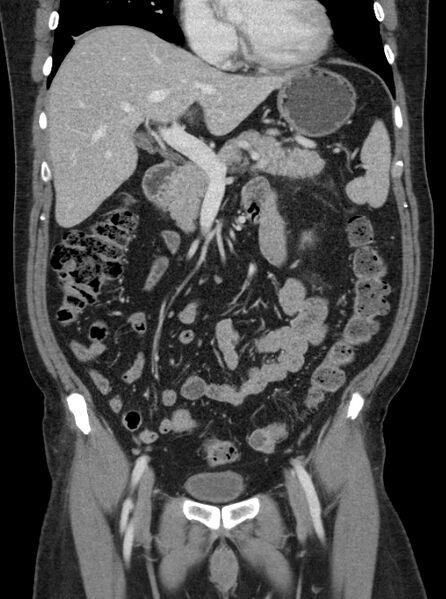 File:Clear cell renal cell carcinoma (Radiopaedia 61449-69393 F 4).jpg