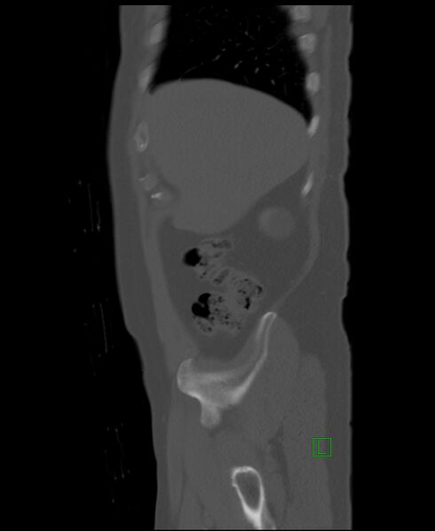 File:Clear cell renal cell carcinoma (Radiopaedia 85006-100539 Sagittal bone window 52).jpg