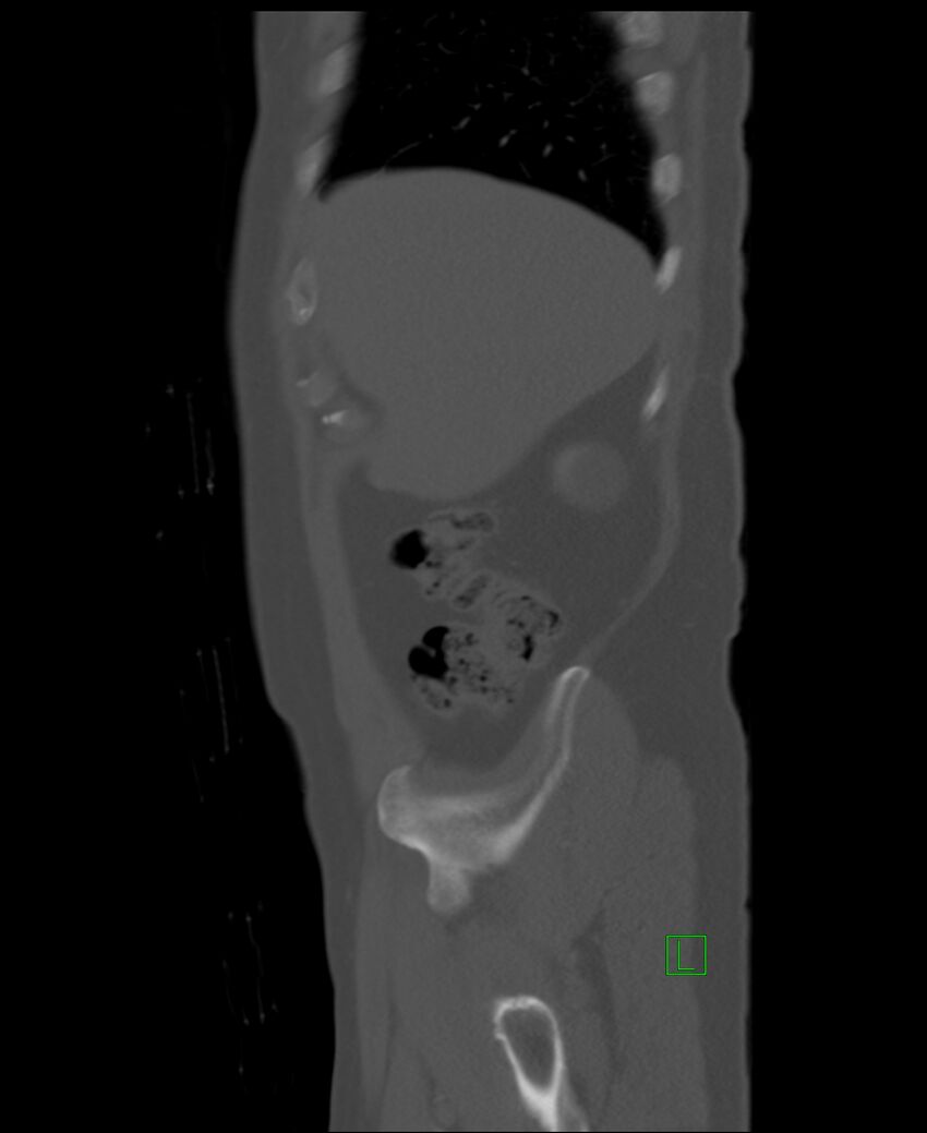 Clear cell renal cell carcinoma (Radiopaedia 85006-100539 Sagittal bone window 52).jpg