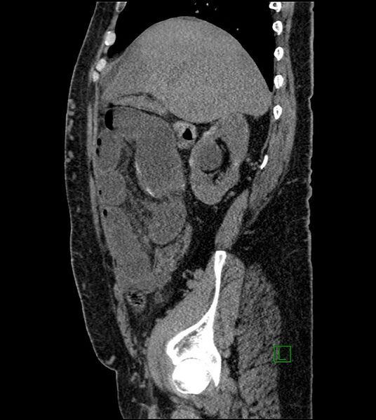 File:Closed-loop small bowel obstruction-internal hernia (Radiopaedia 78439-91096 C 105).jpg