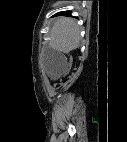 File:Closed-loop small bowel obstruction-internal hernia (Radiopaedia 78439-91096 C 125).jpg