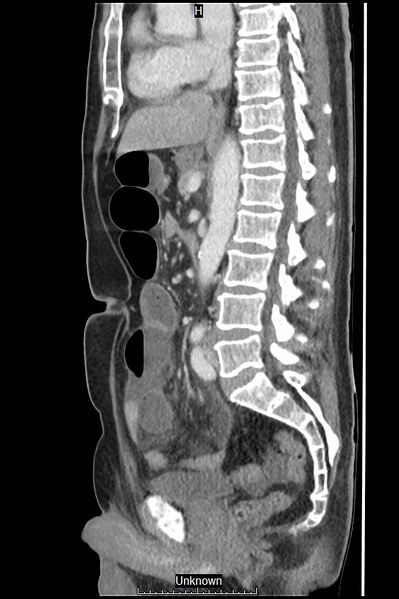 File:Closed loop bowel obstruction and ischemia (Radiopaedia 86959-103180 C 31).jpg