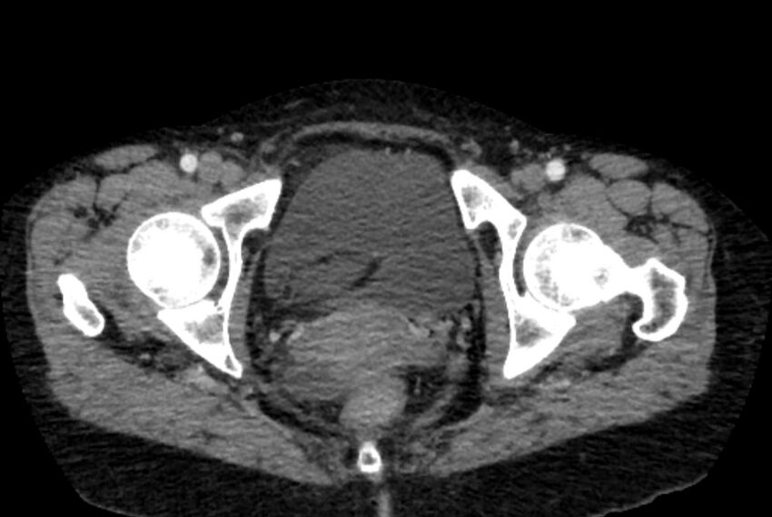 Closed loop small bowel obstruction (Radiopaedia 71211-81508 A 166).jpg