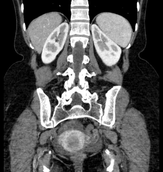 File:Closed loop small bowel obstruction (Radiopaedia 71211-81508 B 97).jpg