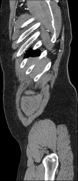 File:Coarctation of the aorta (Radiopaedia 74632-88521 C 307).jpg